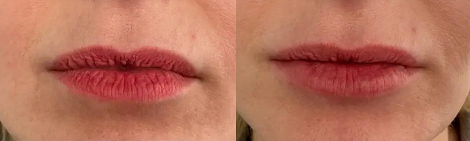 lip blushing removal if gone bad fails fade