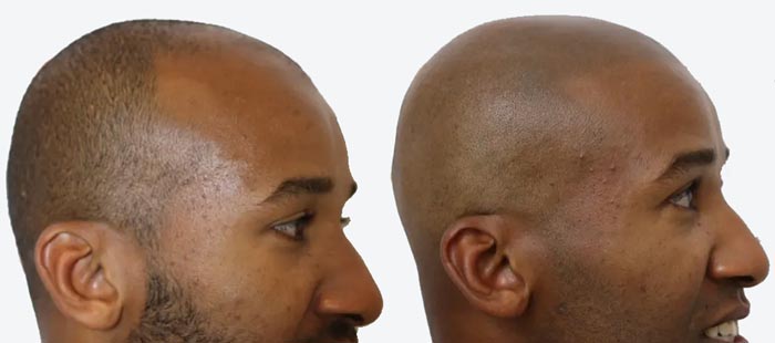 scalp micropigmentation for skin dark fair oily at devilz tattooz