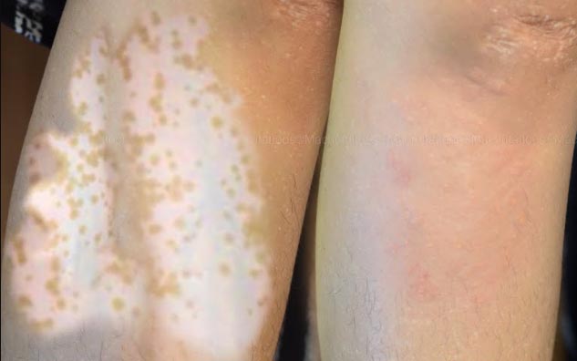 vitiligo micropigmentation tattoo studio cost delhi india at devilz tattooz