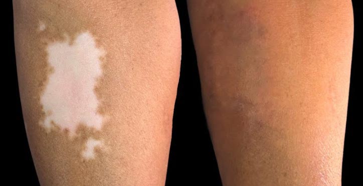 vitiligo tattoo before and after delhi india cost at devilz tattooz