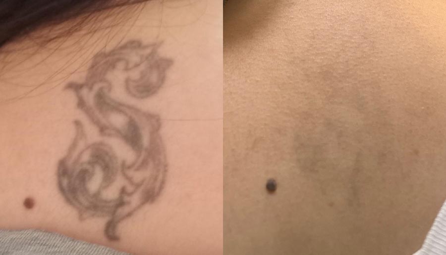 laser permanent tattoo removal delhi cost shop studio at devilz tattooz