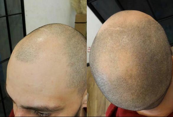 Scalp Micropigmentation (Smp) by Devilz Tattooz at Delhi Tattoo Studio